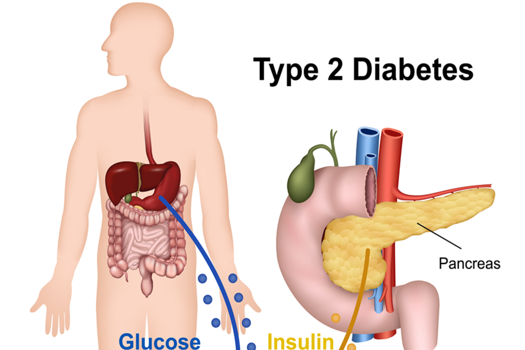 Can You Reverse Type 2 Diabetes? All You Need To Know - Viedial